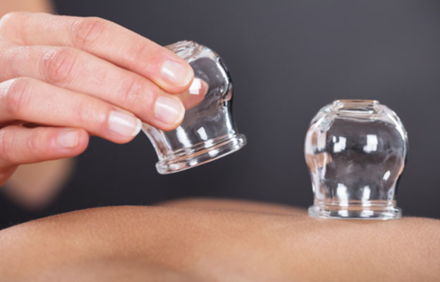 Cupping therapy near Haymarket