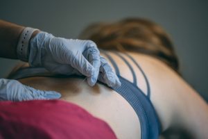 comparing dry needle other massage treatments sydney