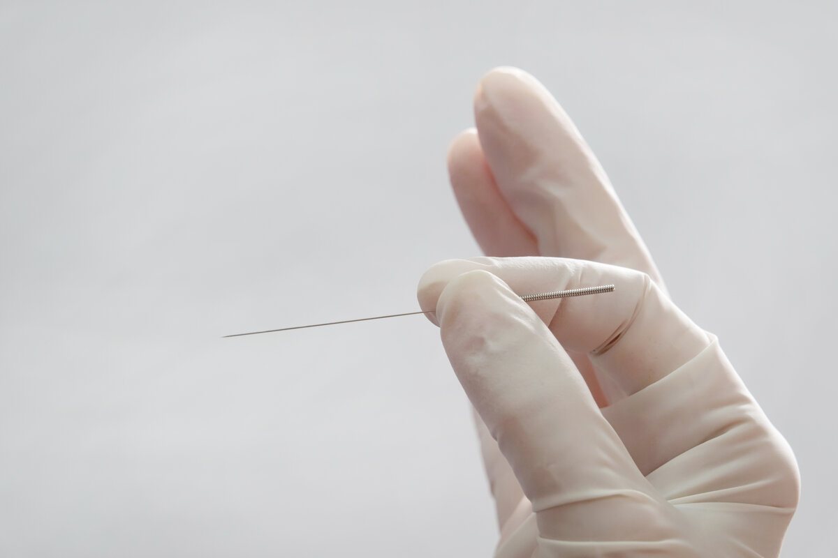 pros and cons of dry needling sydney